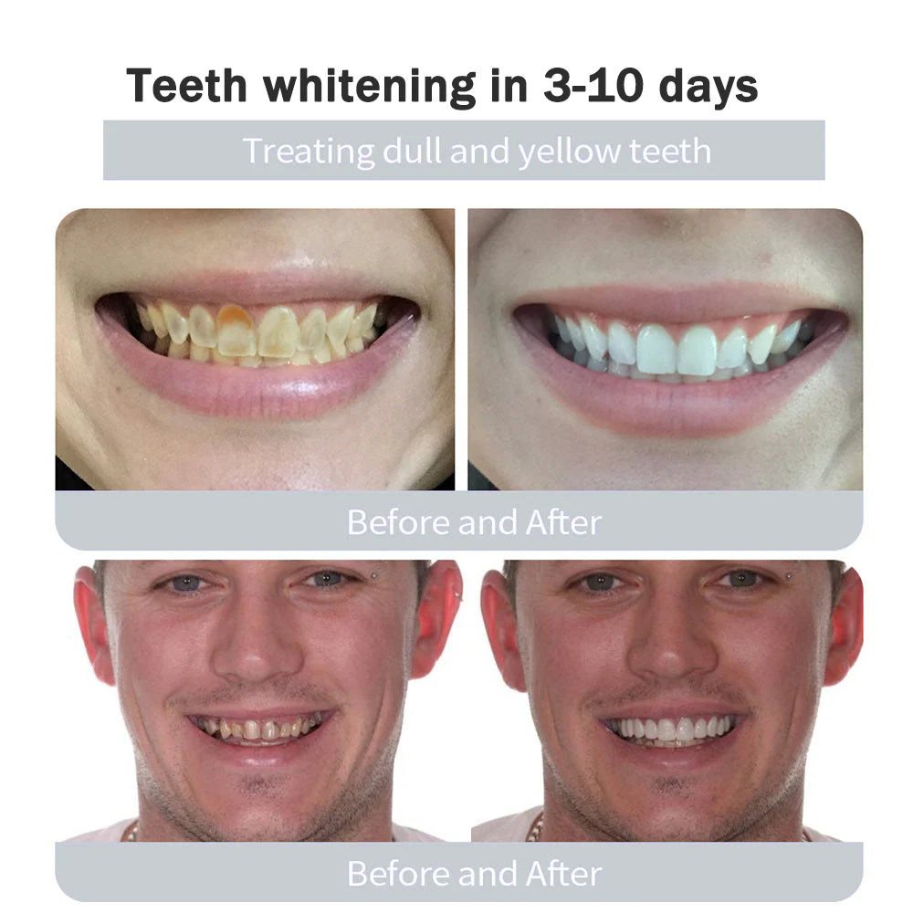 Whitening Kit