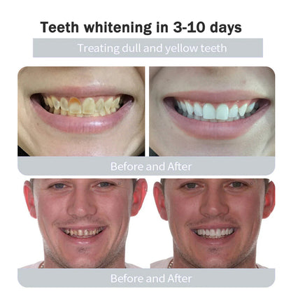 Whitening Kit