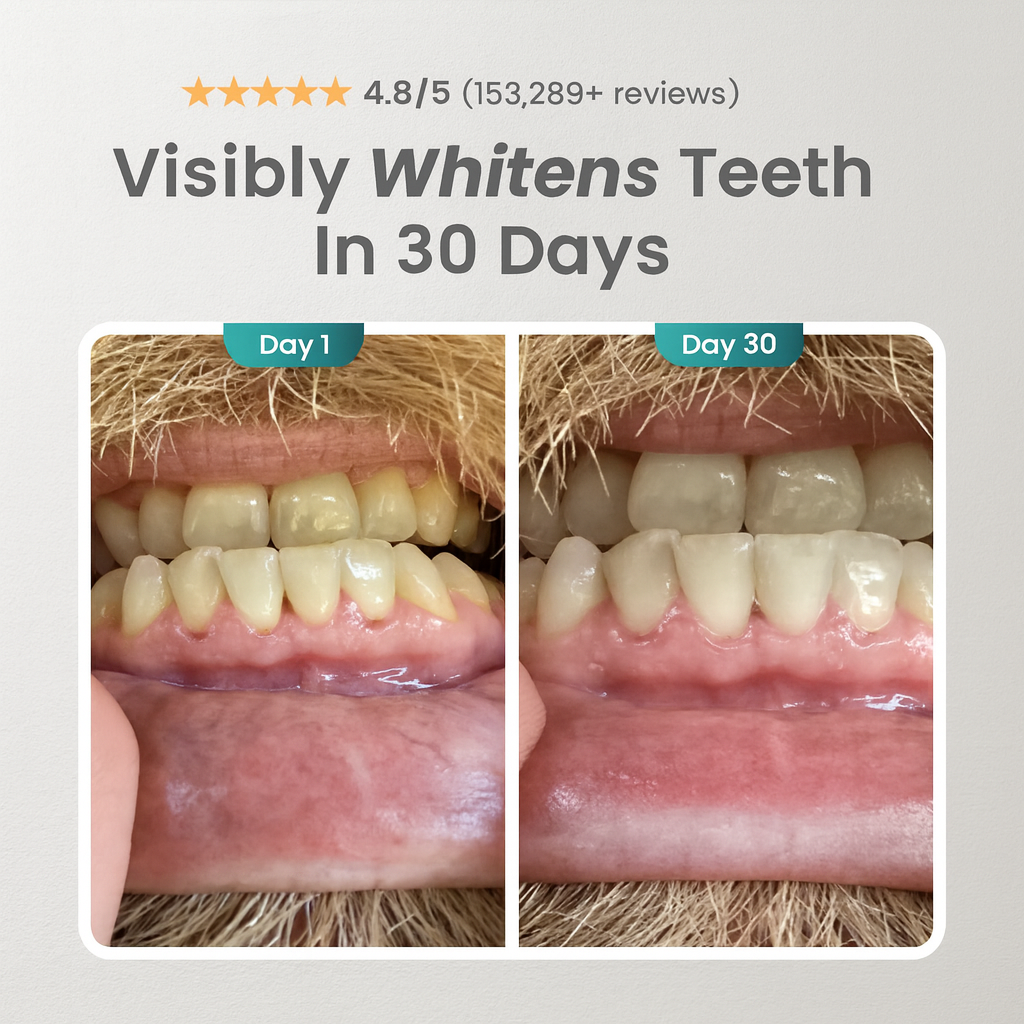 Whitening Kit